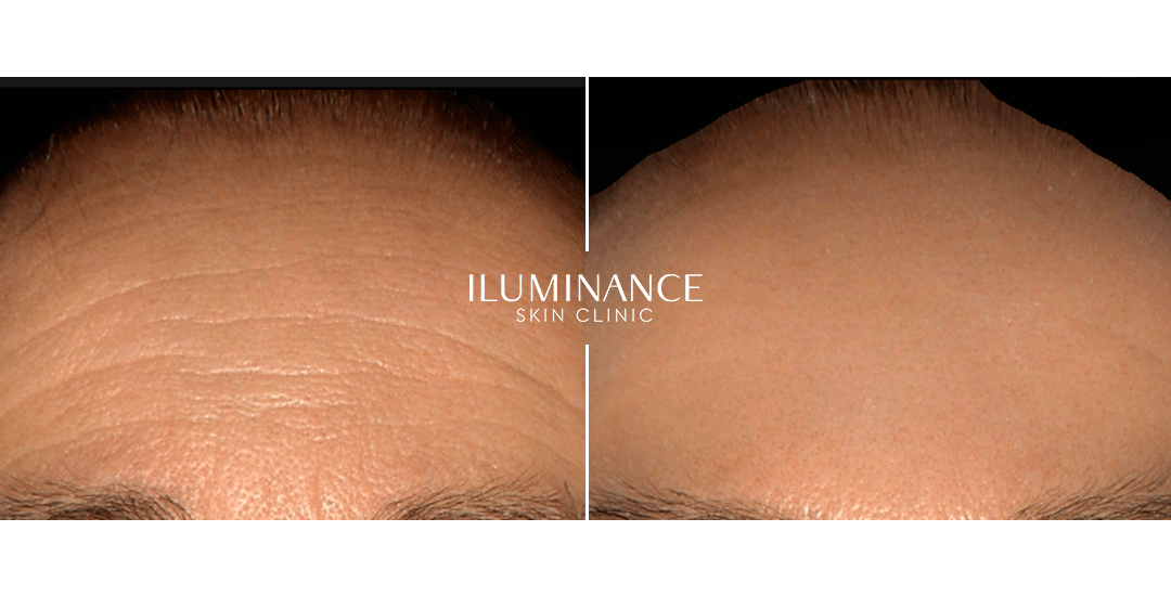 Botox - After Before - results 1 - Iluminance skin clinic