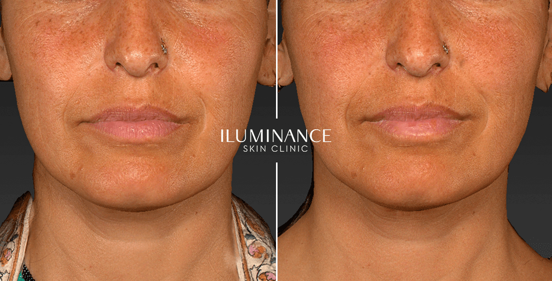 Botox - After Before - results 2 - Iluminance skin clinic