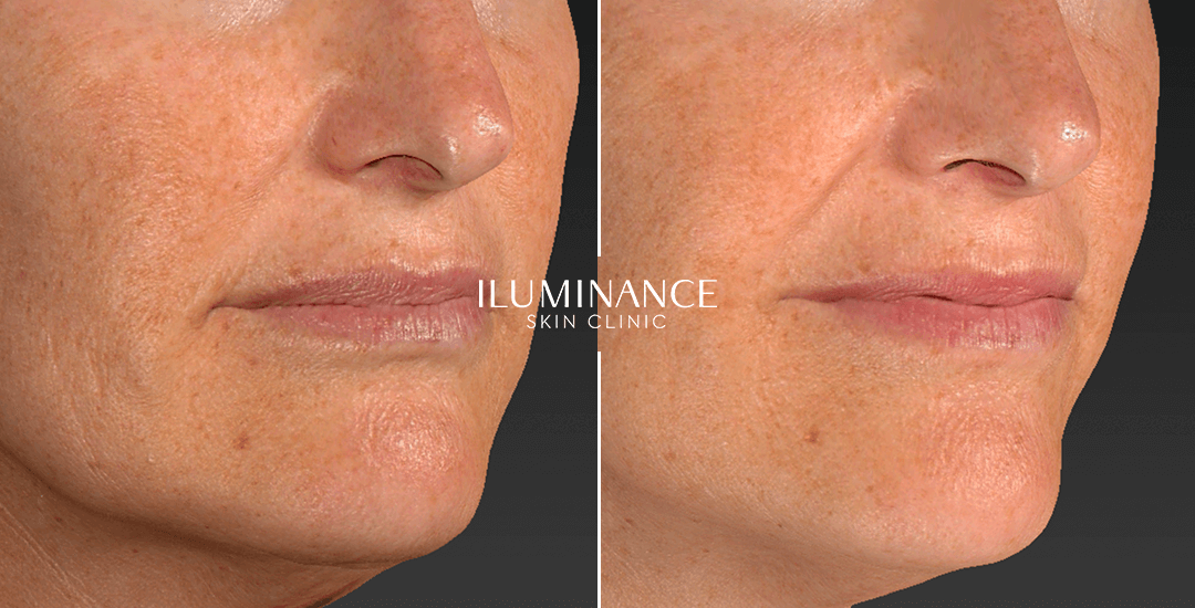 Collagen - After Before - results 1 - Iluminance skin clinic