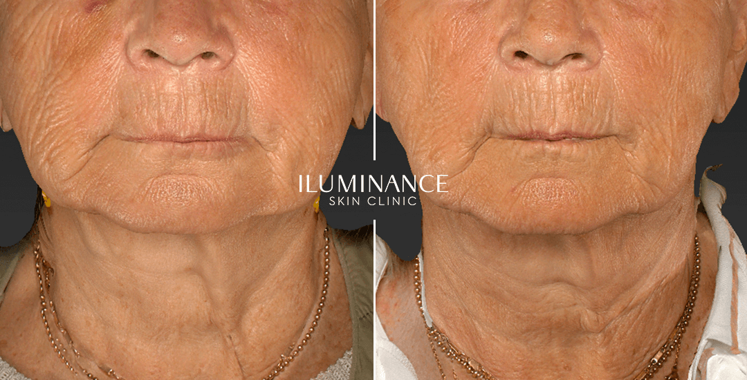 Collagen - After Before - results 2 - Iluminance skin clinic