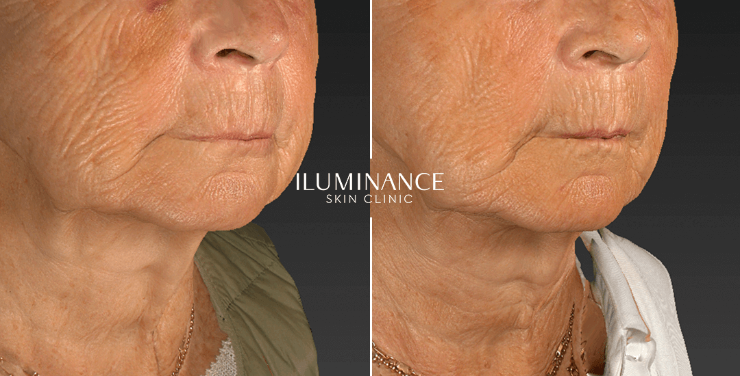 Collagen - After Before - results 3 - Iluminance skin clinic