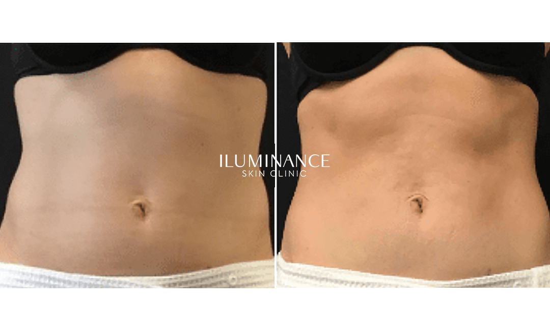 Emslim - After and Before - results 1 - Iluminance skin clinic