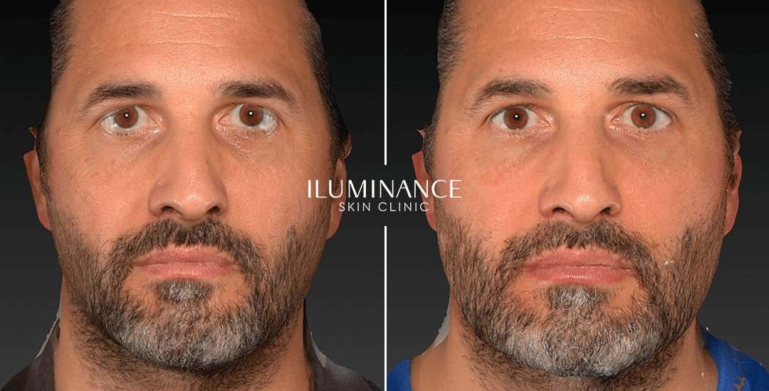 Harmonization - After Before - results 10 - Iluminance skin clinic