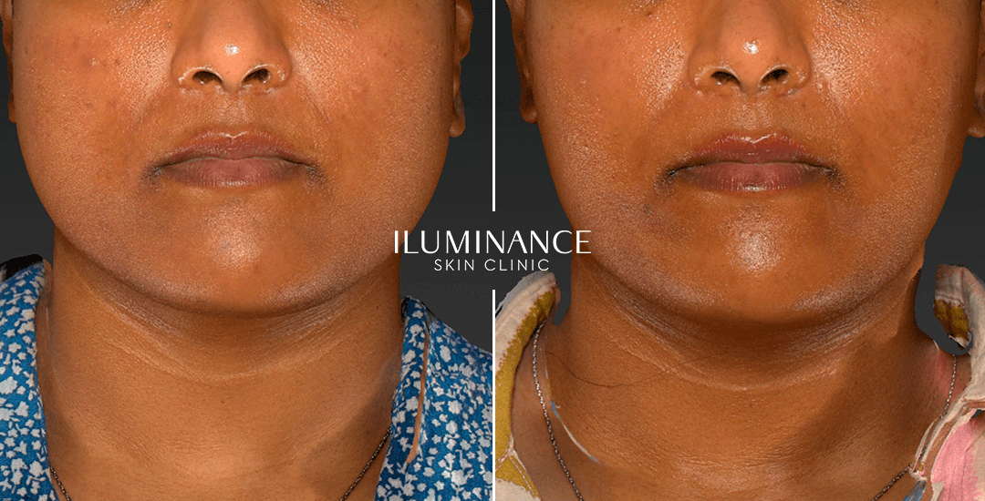 Harmonization - After Before - results 2 - Iluminance skin clinic