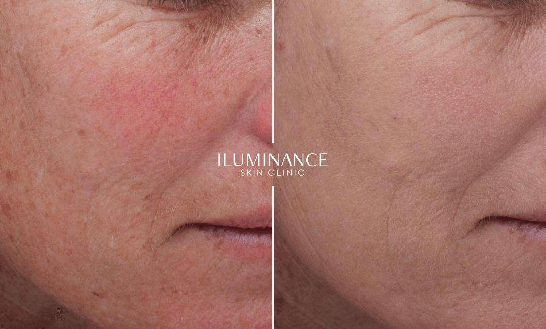 Moxi - After and Before - results 1 - Iluminance skin clinic