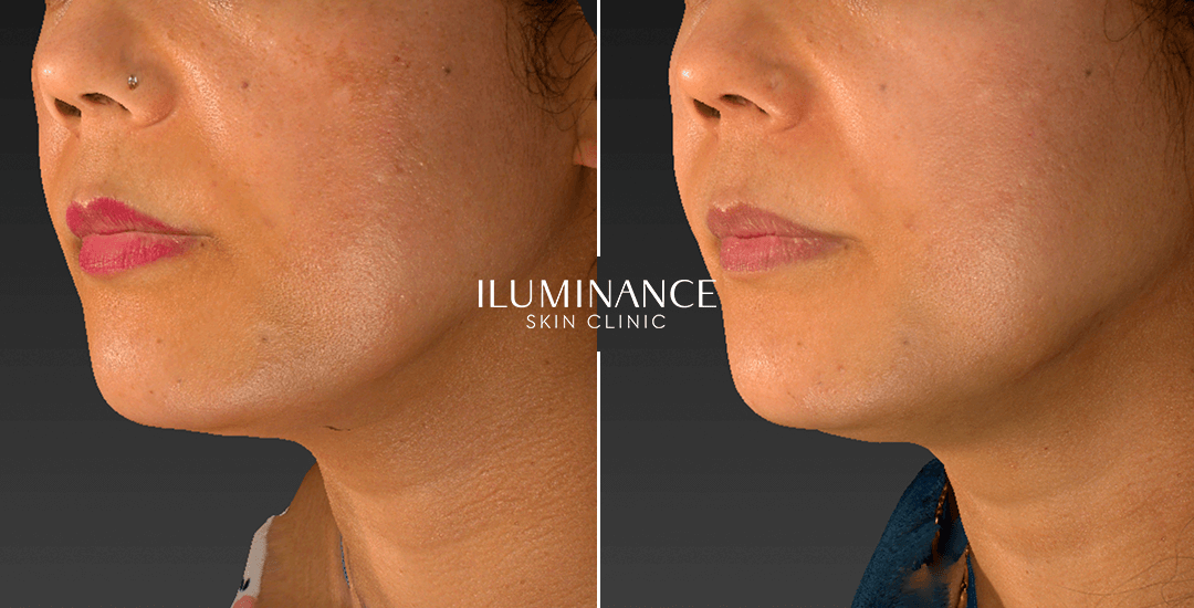 Peeling - After Before - results 1 - Iluminance skin clinic