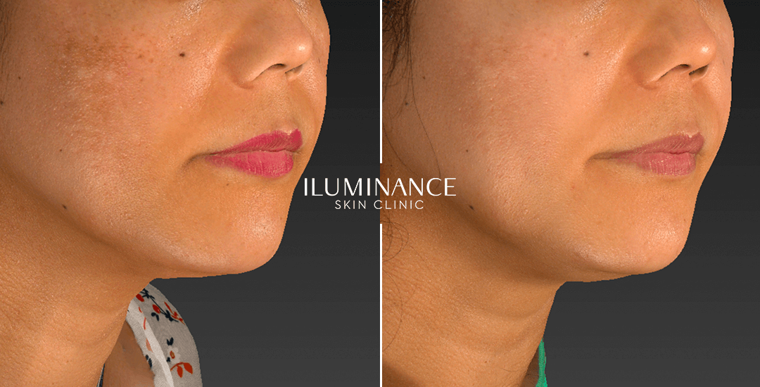Peeling - After Before - results 2 - Iluminance skin clinic