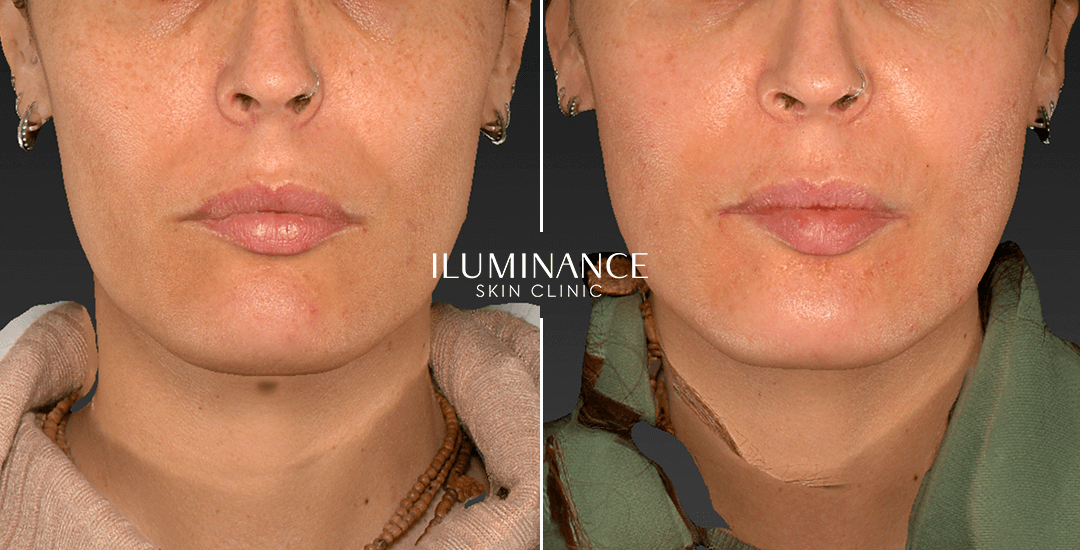 Peeling - After Before - results 3 - Iluminance skin clinic