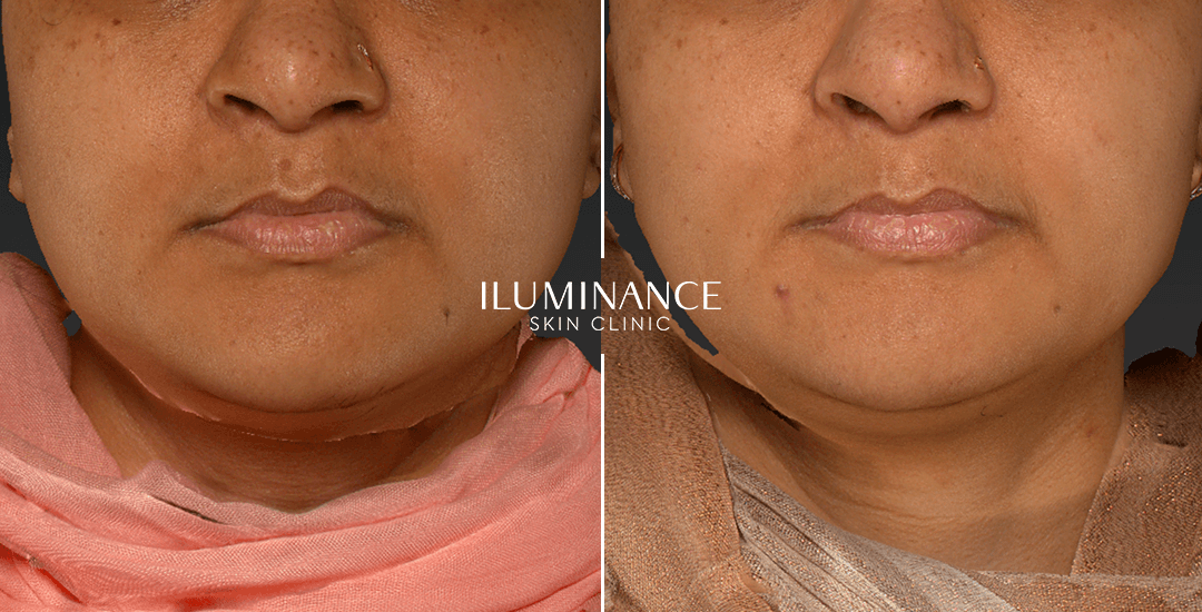 Peeling - After Before - results 4 - Iluminance skin clinic