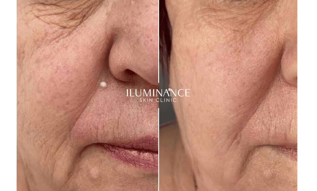 Skin Boosters - 01 - Antes e Depois