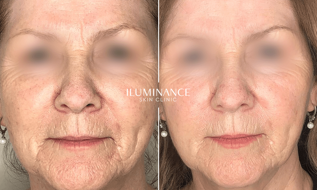 Skin Boosters - 02 - Antes e Depois