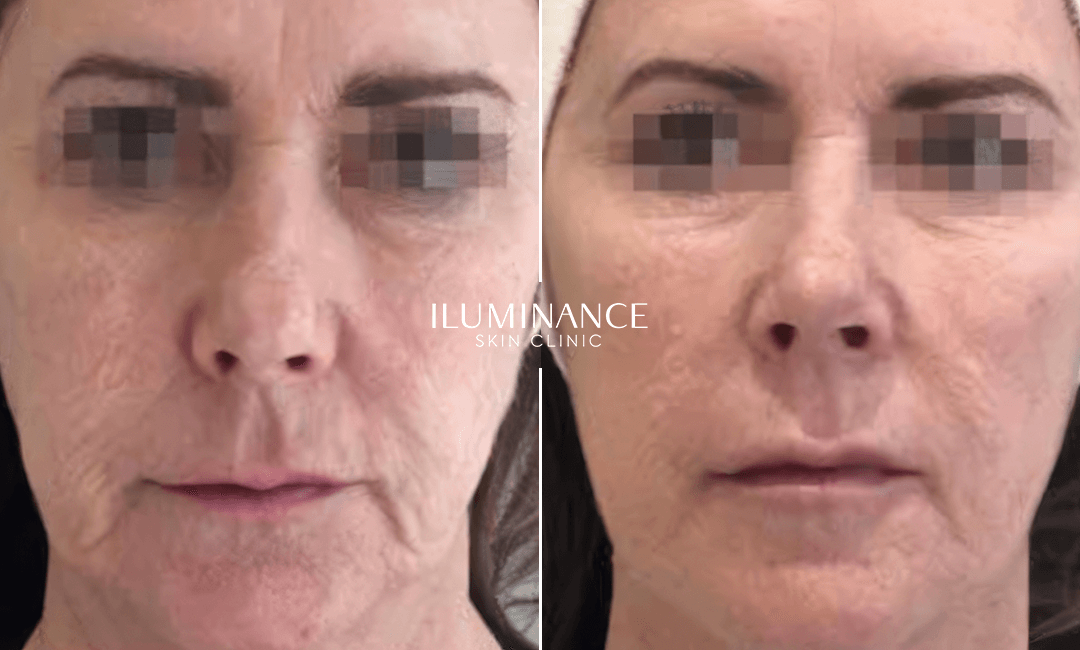 Skin Boosters - 03 - Antes e Depois