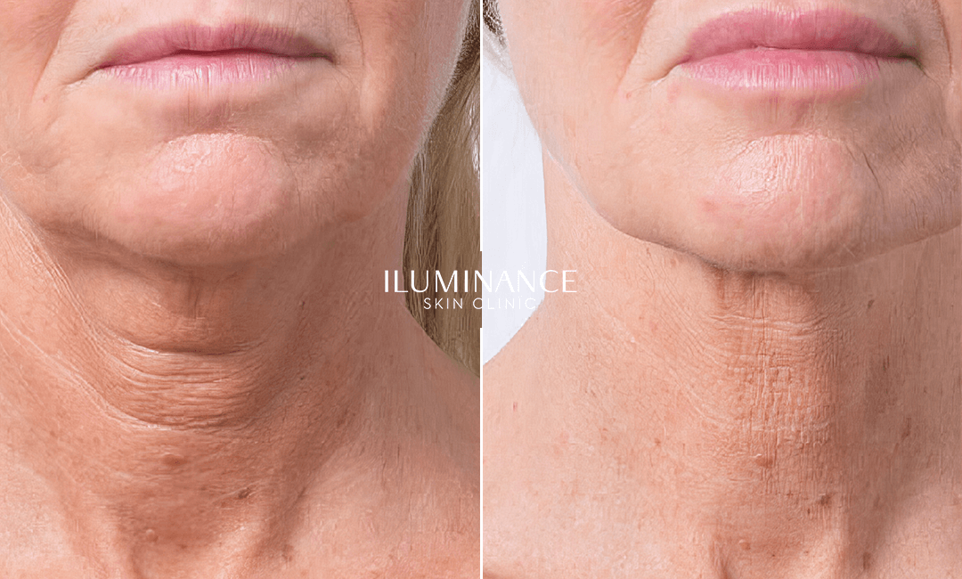 Skin Boosters - 04 - Antes e Depois