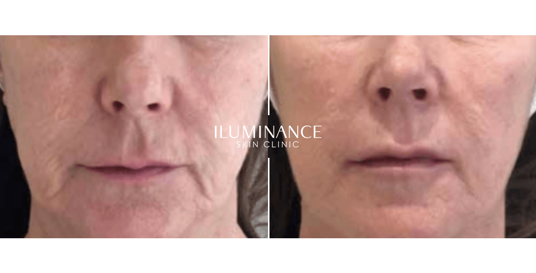 Skinbooster - After Before - results 1 - Iluminance skin clinic