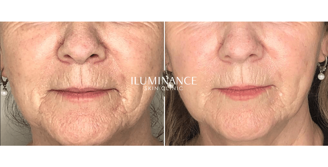 Skinbooster - After Before - results 2 - Iluminance skin clinic