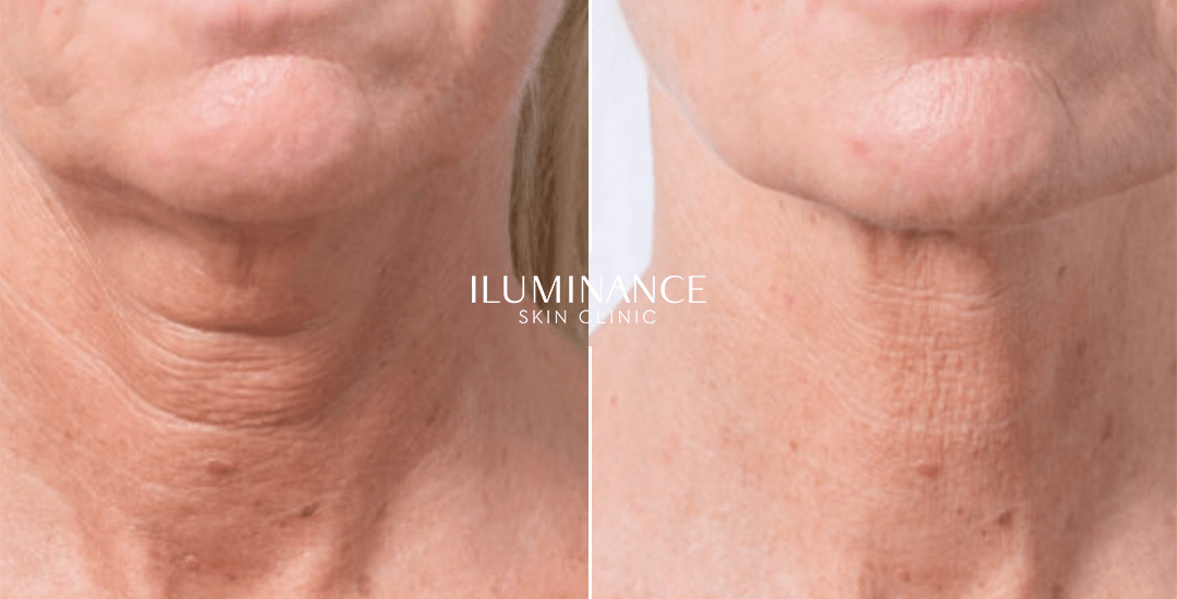 Skinbooster - After Before - results 3 - Iluminance skin clinic