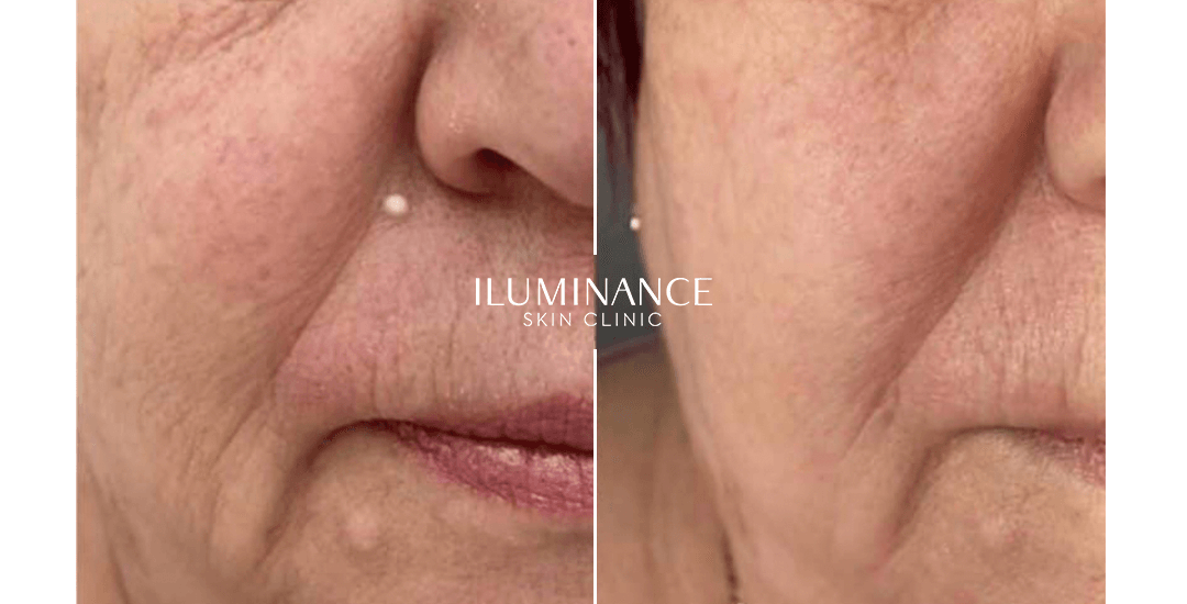 Skinbooster - After Before - results 4 - Iluminance skin clinic