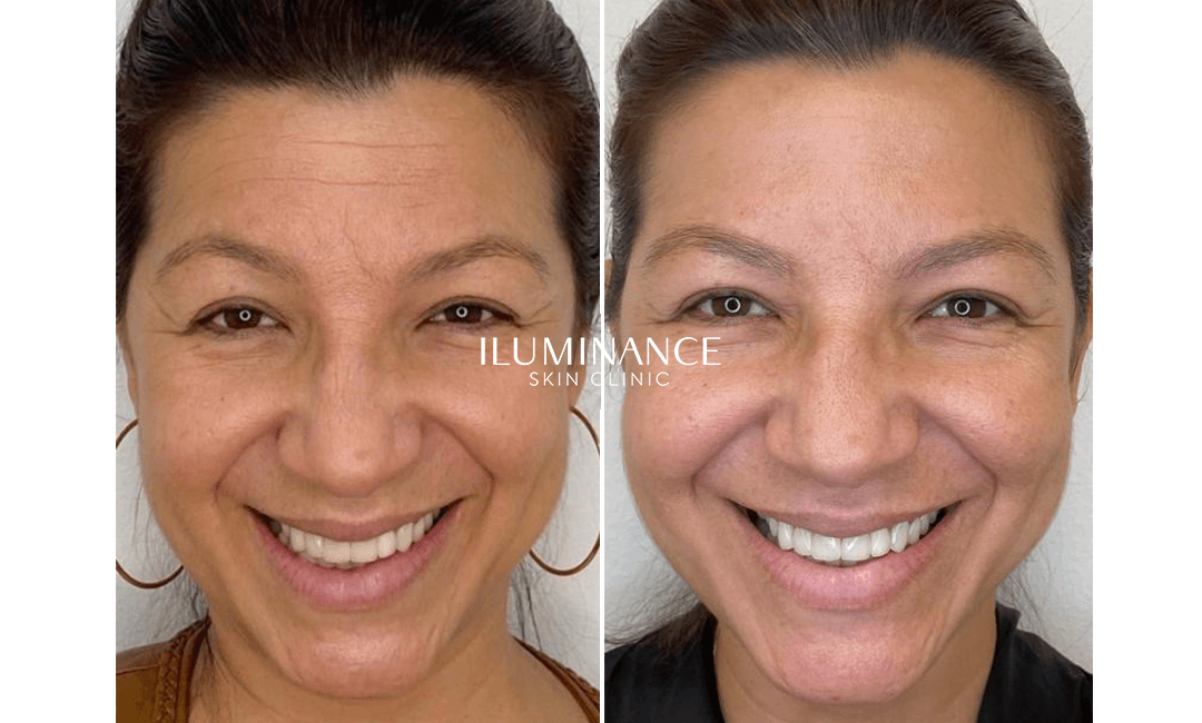 Botox - 21