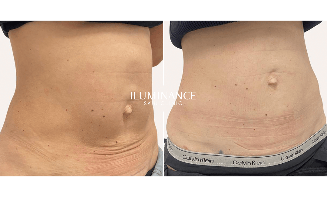 Collagen Lenisna - 28