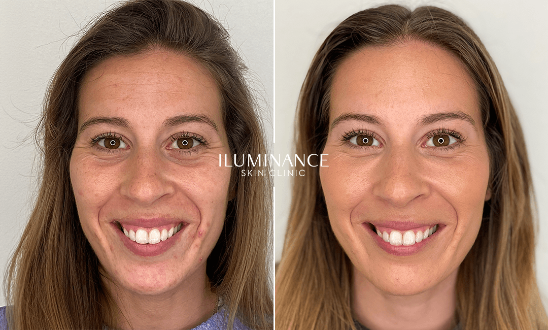 Harmonização e Botox - 22