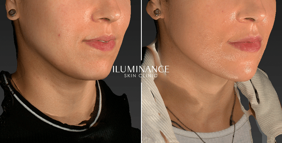 Jawline e Harmonização - 1