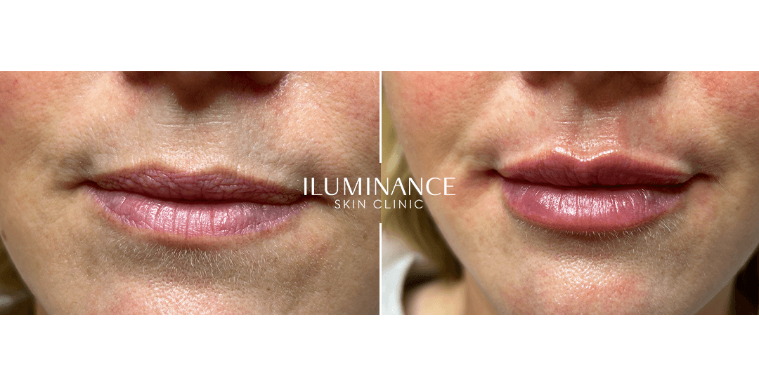 Lip Filler - 17