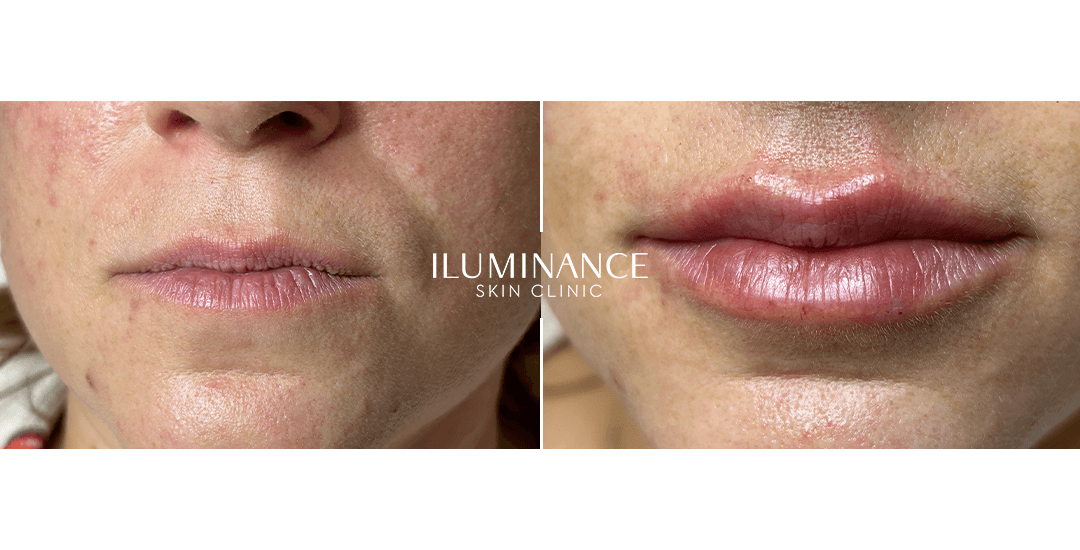 Lip Filler - 18