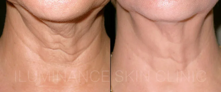 NON-SURGICAL-SKIN-TIGHTENING